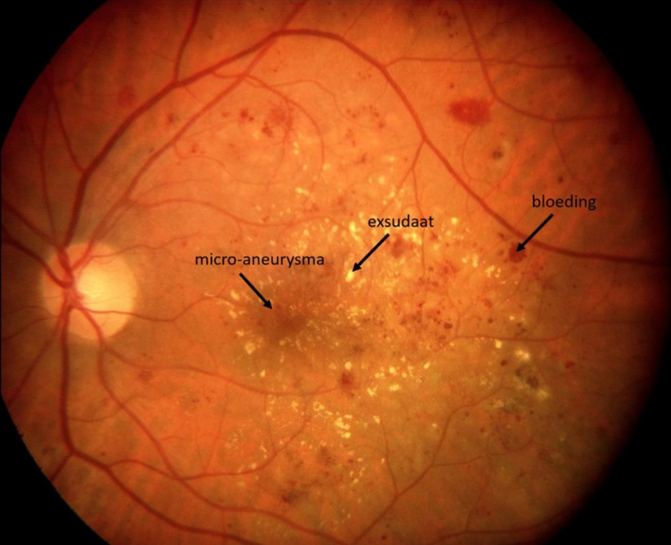 Diabetescomplicaties in het oog