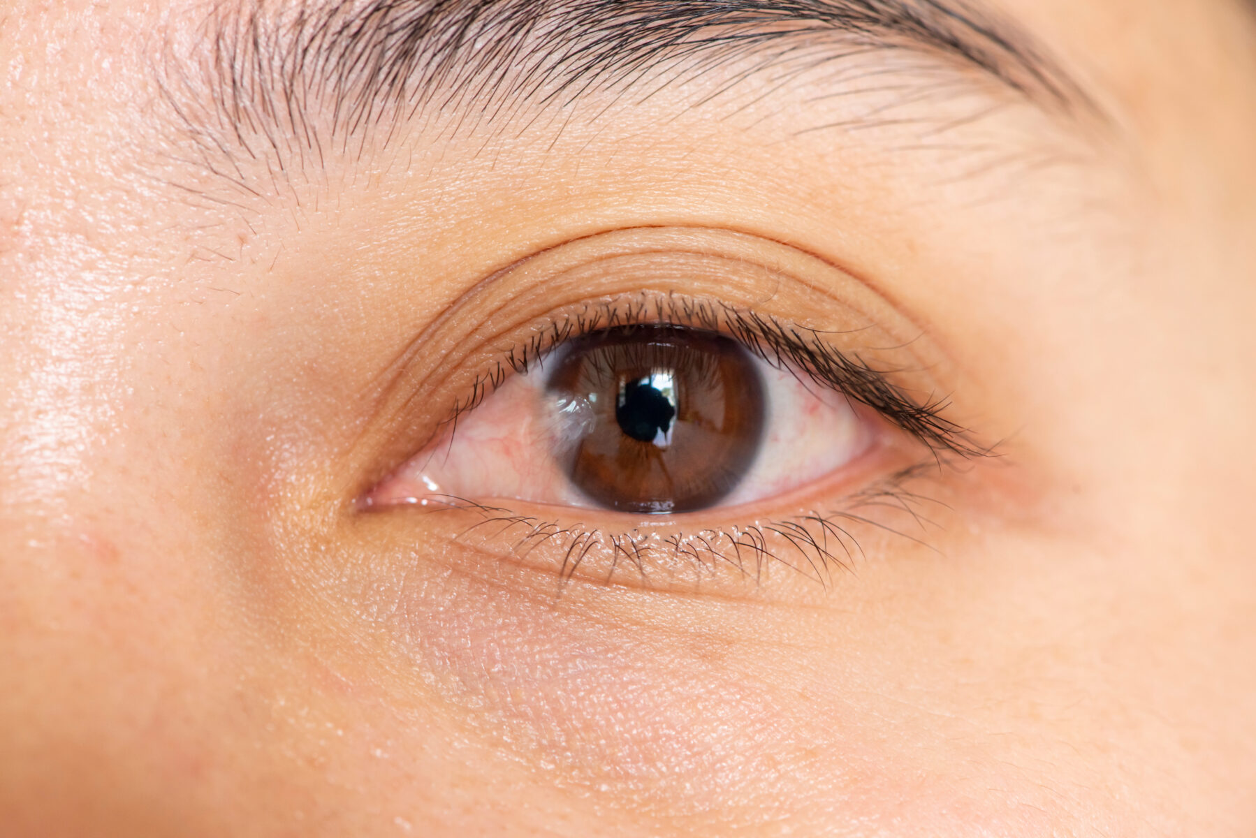 Pterygium