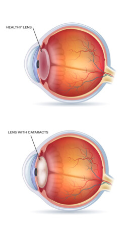 cataract behandeling lens