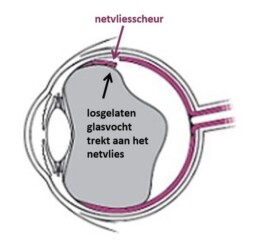 netvliesscheur