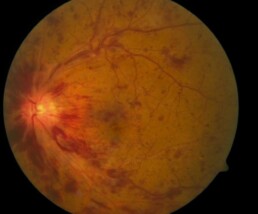 retinale veneuze occlusie - rvo